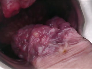 Gaping Inside  view of my extreme Prolapse asshole